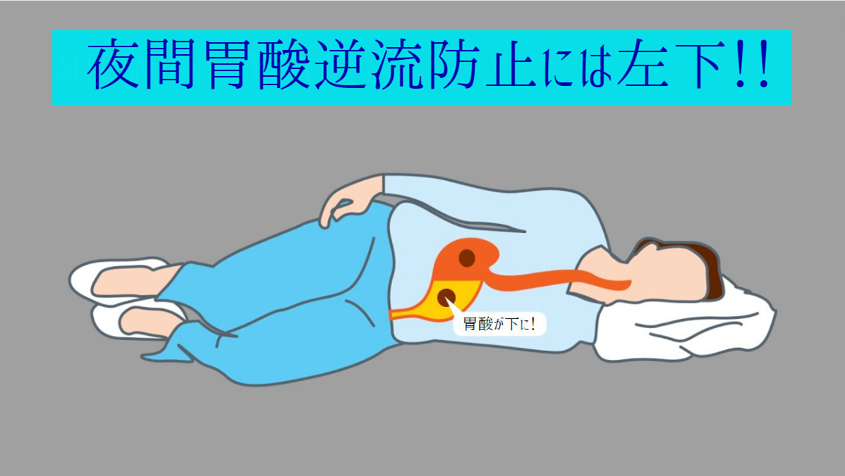 逆流性食道炎の治療