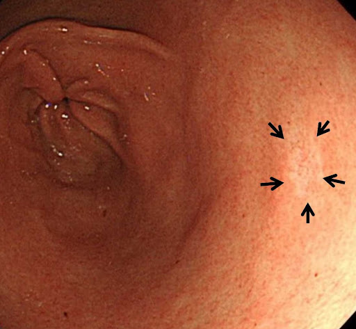 胃粘膜の色の変化 