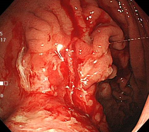 胃がんの内視鏡画像