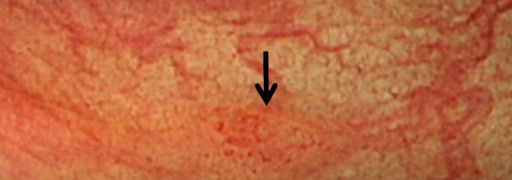 大腸ポリープの形状 