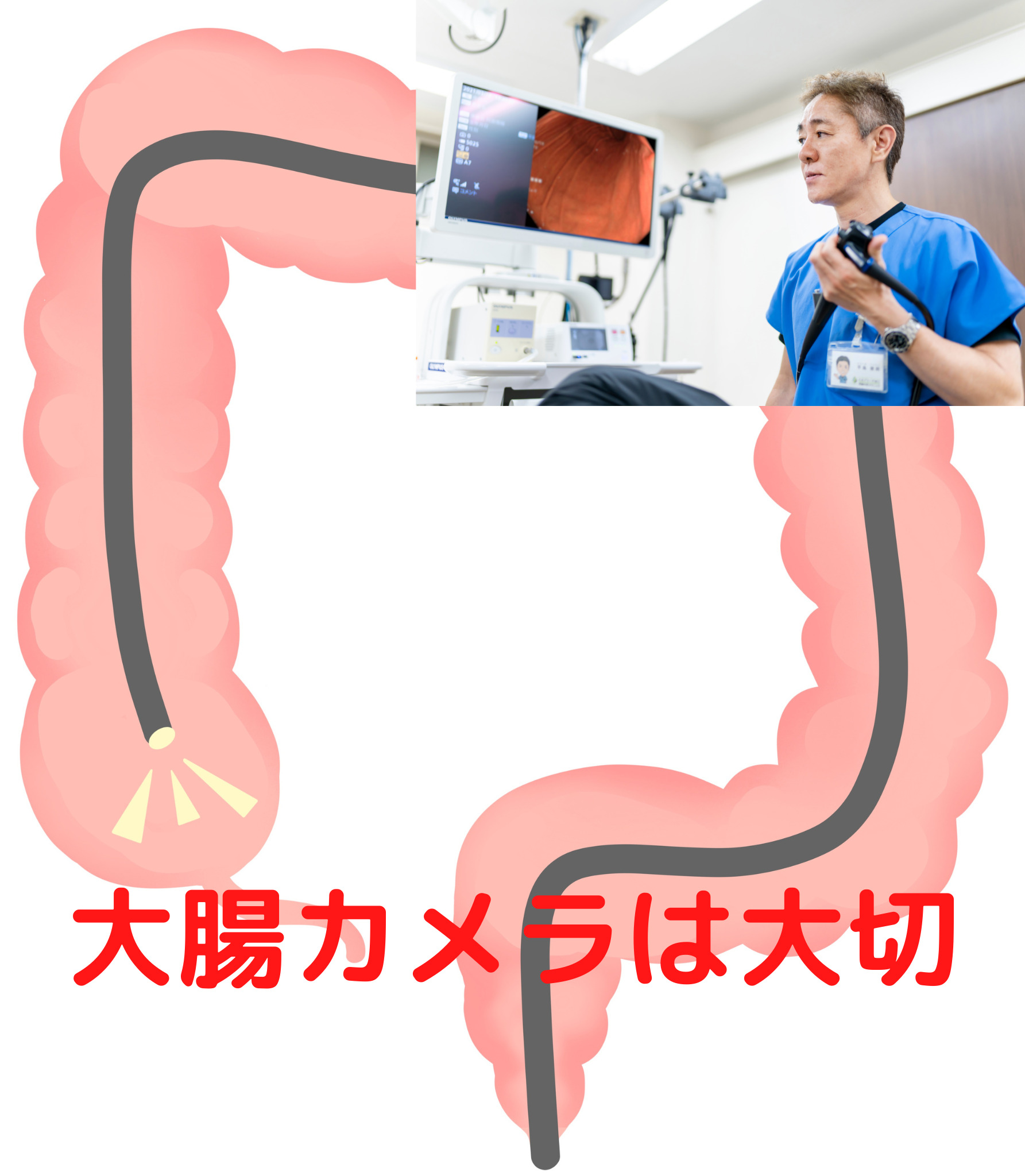 大腸ポリープを切除することは「究極の大腸がん予防」！？