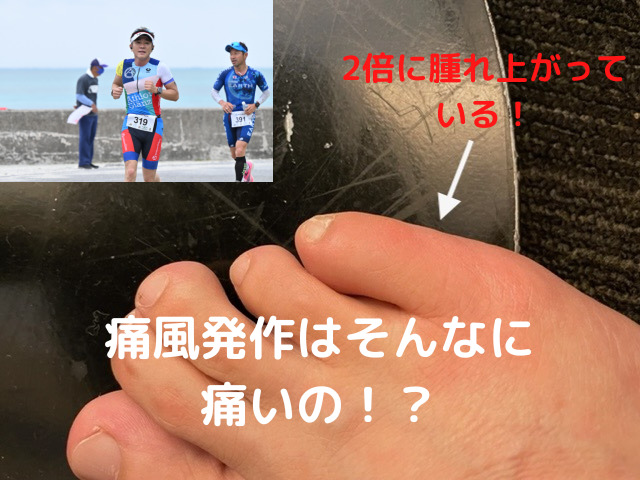 痛風発作って風が吹いても痛いの！？