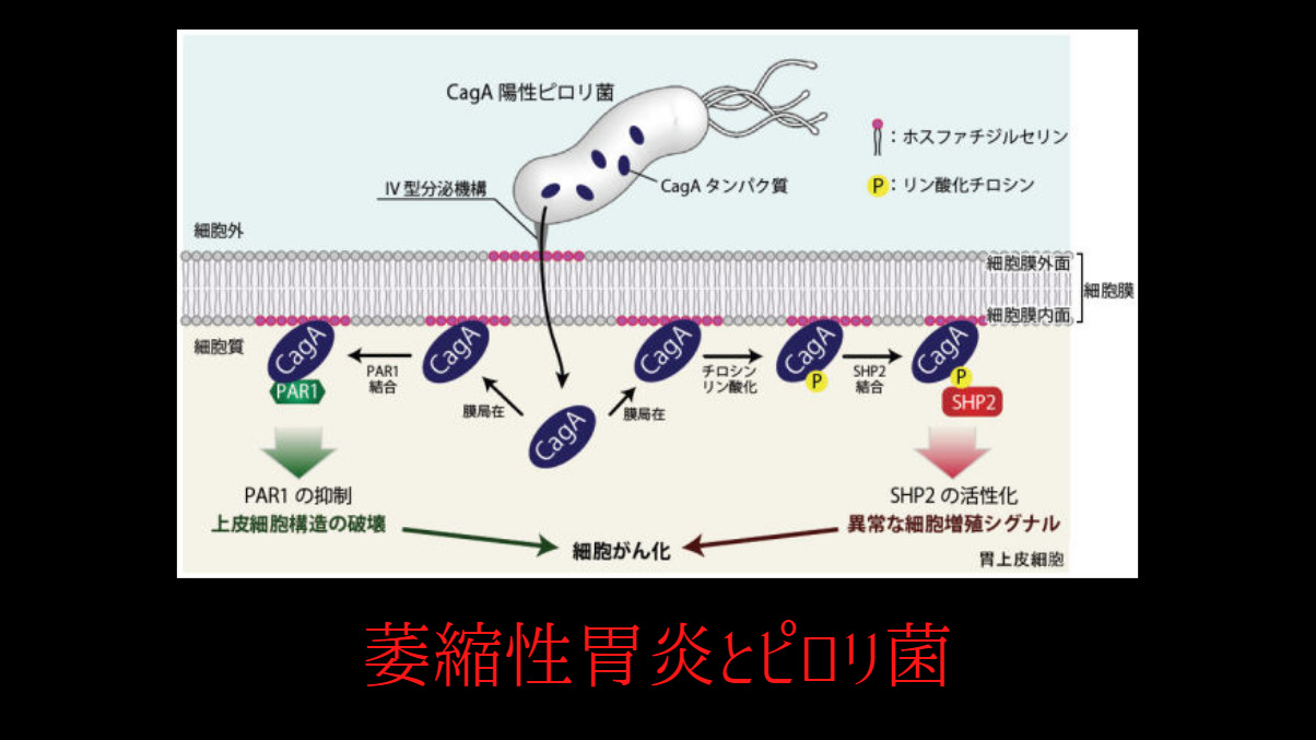 萎縮性胃炎とピロリ菌