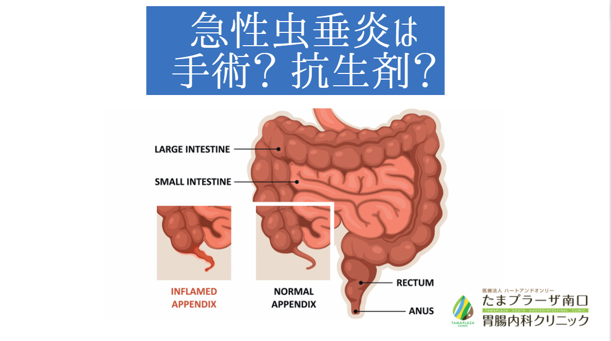 急性虫垂炎は手術？ 抗生剤？