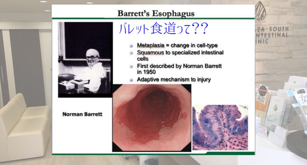 バレット食道がある場合に食べるべき食べ物