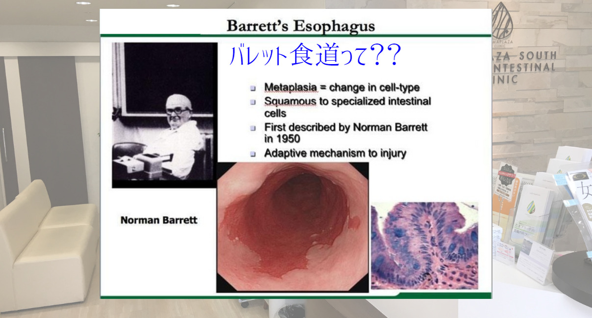 バレット食道とは？？