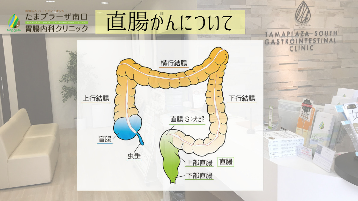 直腸がんについて