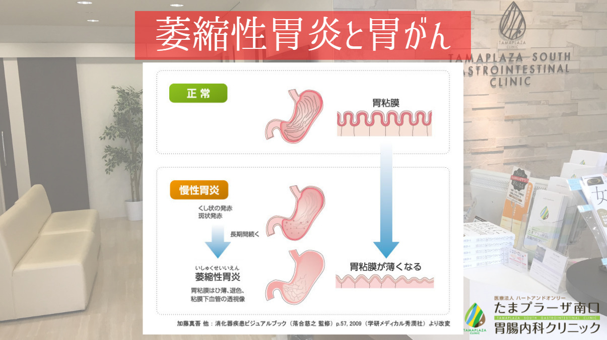 萎縮性胃炎と胃がん