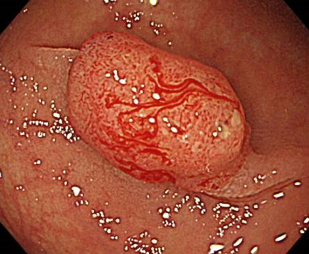 大腸がんの症例