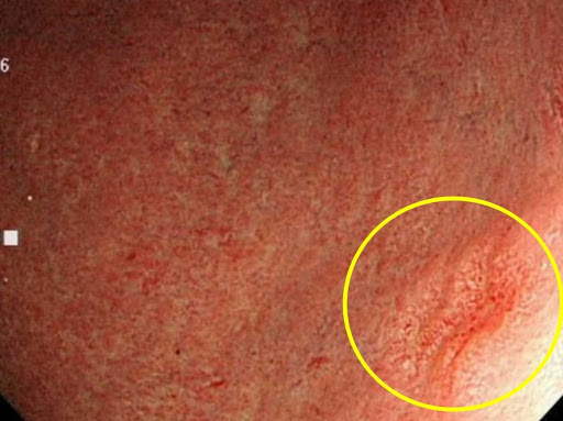ピロリ菌除菌除後の早期胃がん