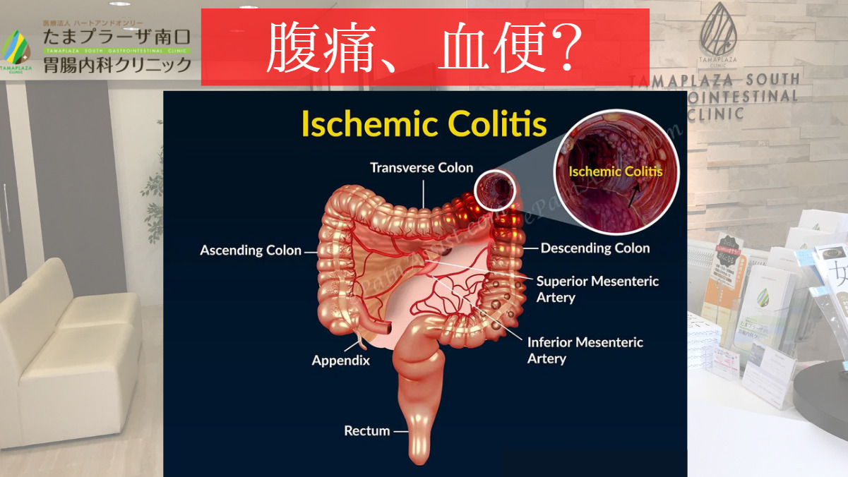 突然の腹痛、血便は？