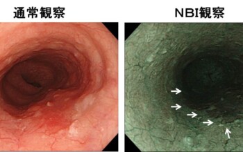 食道がんについて知ろう！