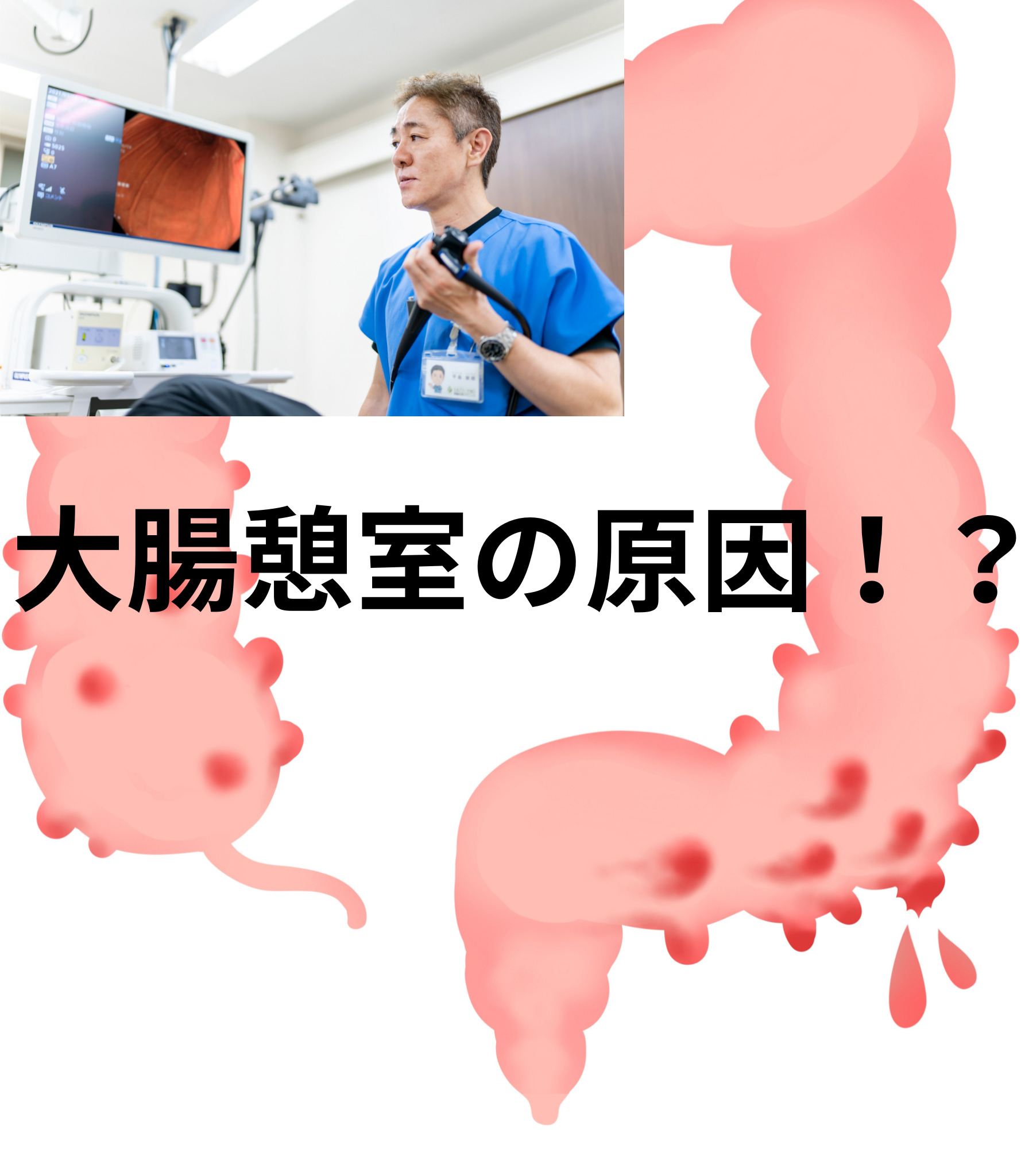 大腸憩室と大腸憩室炎