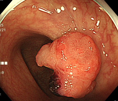 大腸がんの症例
