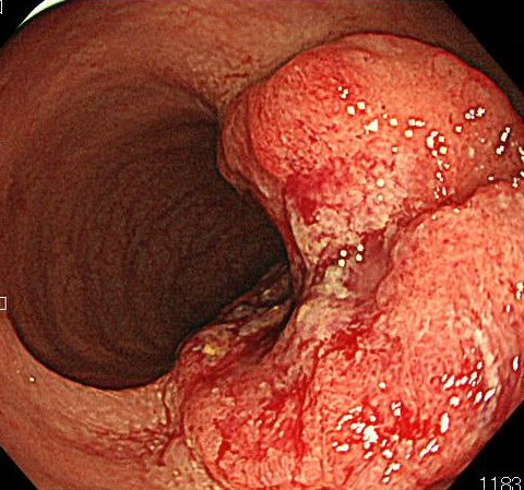 大腸がんの症例