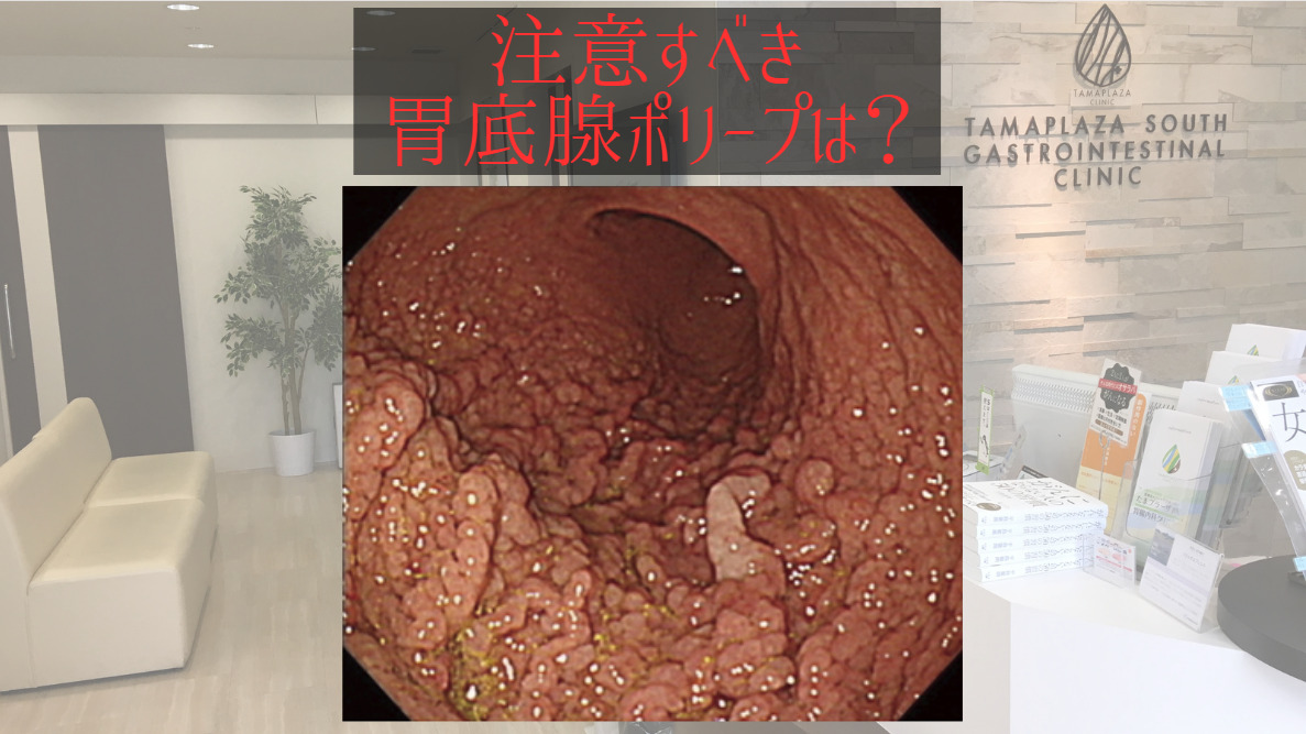 注意すべき胃底腺ポリープは？