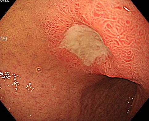 十二指腸潰瘍の内視鏡写真