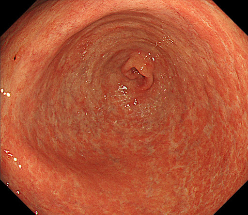 萎縮性胃炎の内視鏡画像