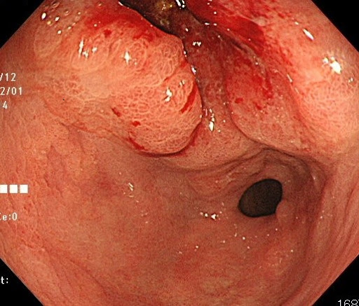 胃がんの内視鏡写真