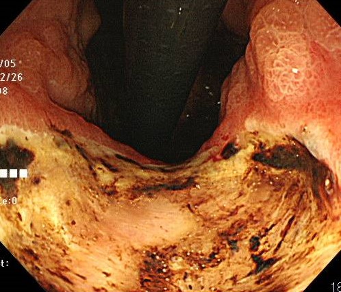 胃潰瘍の内視鏡画像