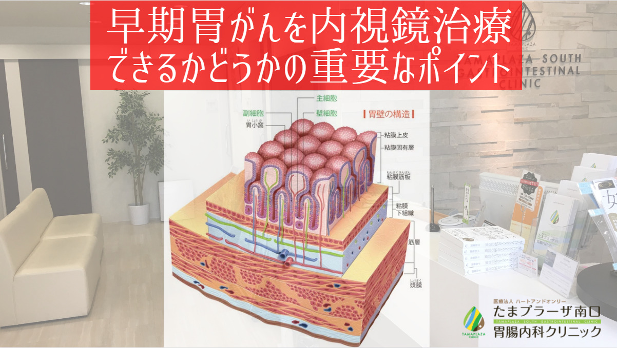 早期胃がんを内視鏡治療できるかどうかの重要なポイント