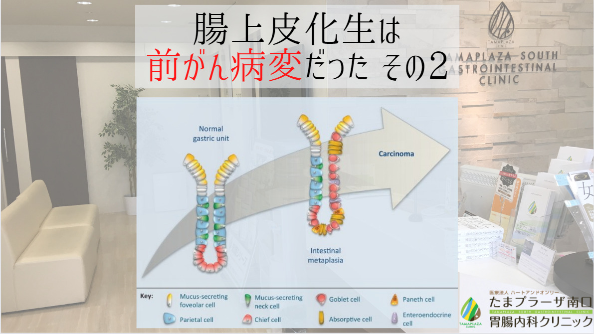 胃の腸上皮仮生は前がん病変だった　その2