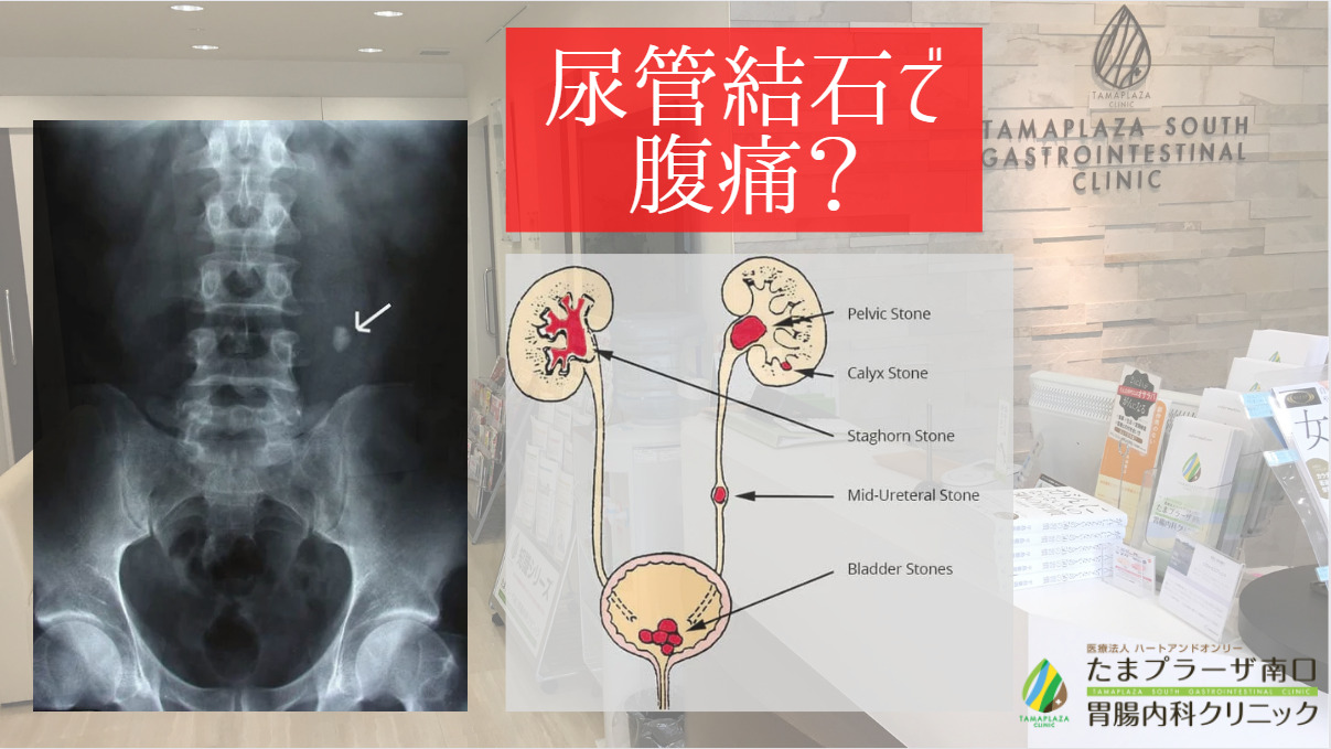 尿管結石で腹痛？