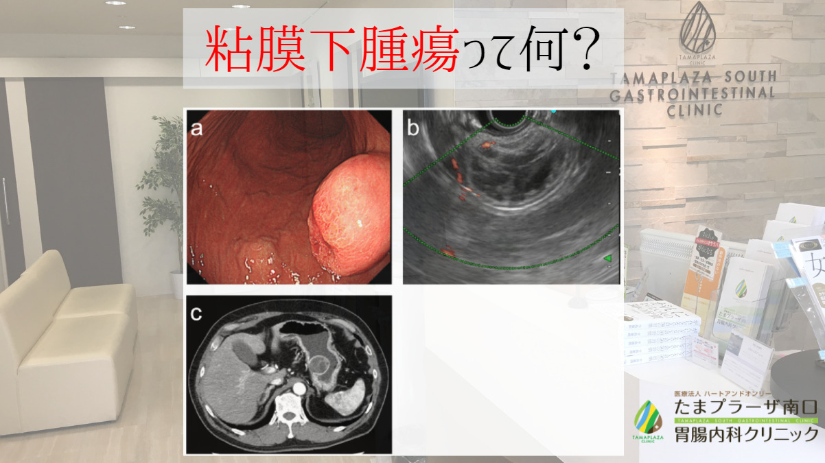 粘膜下腫瘍って何？