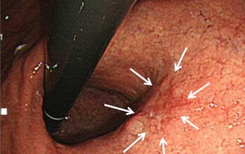 あなたの「がん」見逃されてない？　見逃しのない内視鏡検査について解説