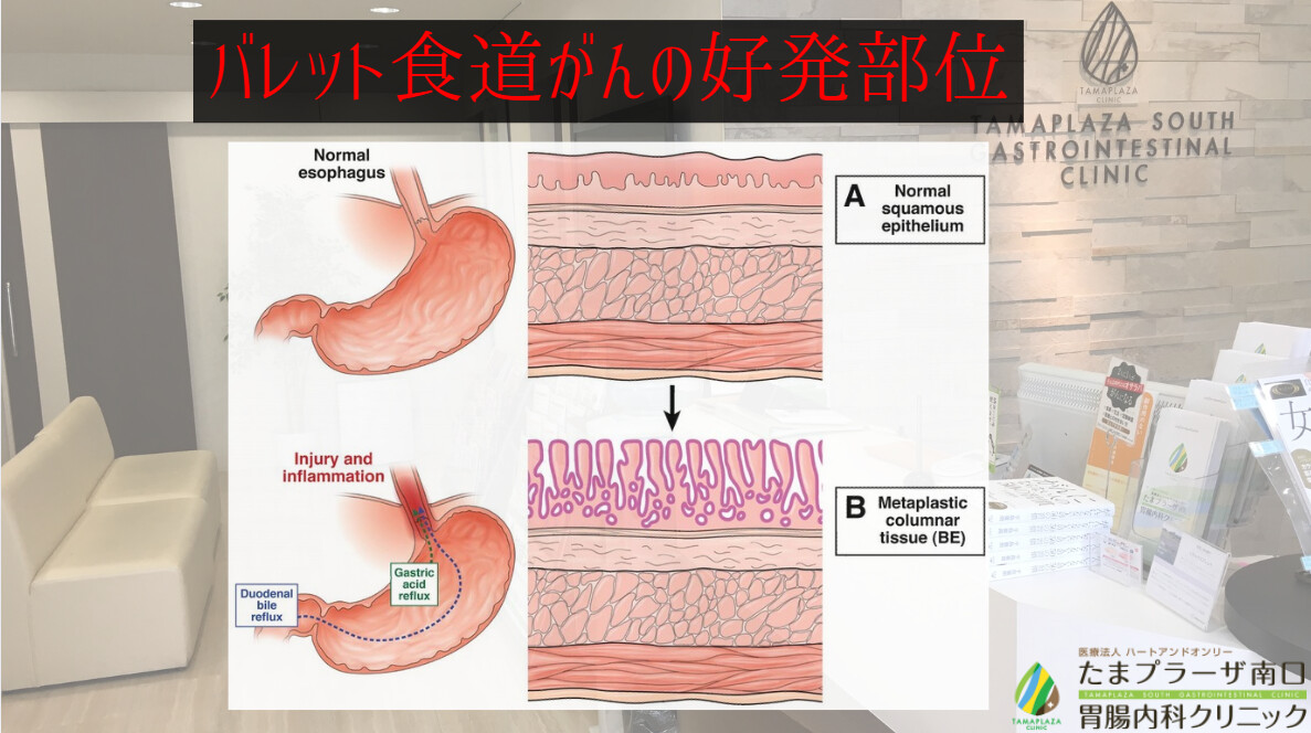 バレット食道がんの好発部位 消化器内視鏡横浜青葉区院